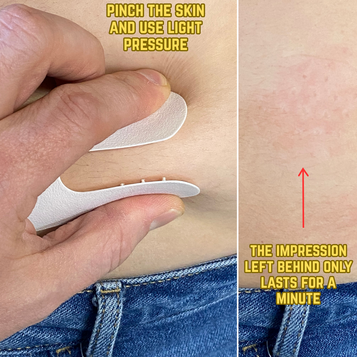 Injection Comfort Aide - ShotEase (2 per pack) - Tactile Pain Distraction and Injection Site Guide